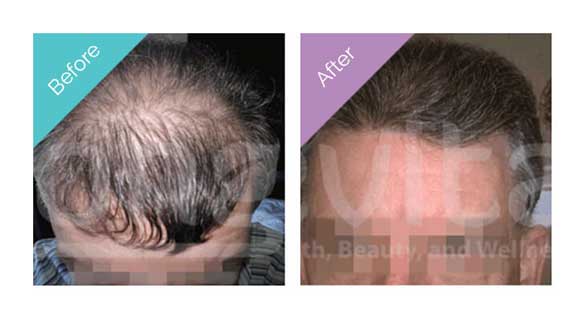 Longevita Hair Transplant Before After 4